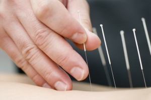 thetole acupuncture alternative treatment malaysia
